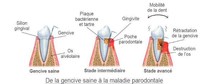 tartre et maladie parodontale